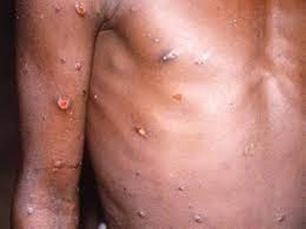 Brasil já tem cinco casos confirmados de varíola dos macacos e imunologista dá dicas de como se prevenir da doença 